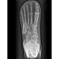 X-Ray Phantom Foot, transparent 2