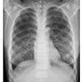 Poitrine pour Fantôme Thorax N-1 LUNGMAN 2